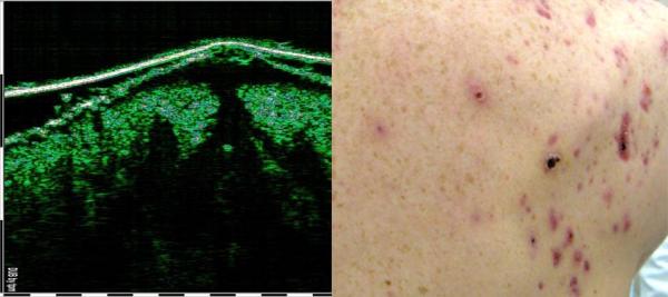acne conglobata 75 MHz